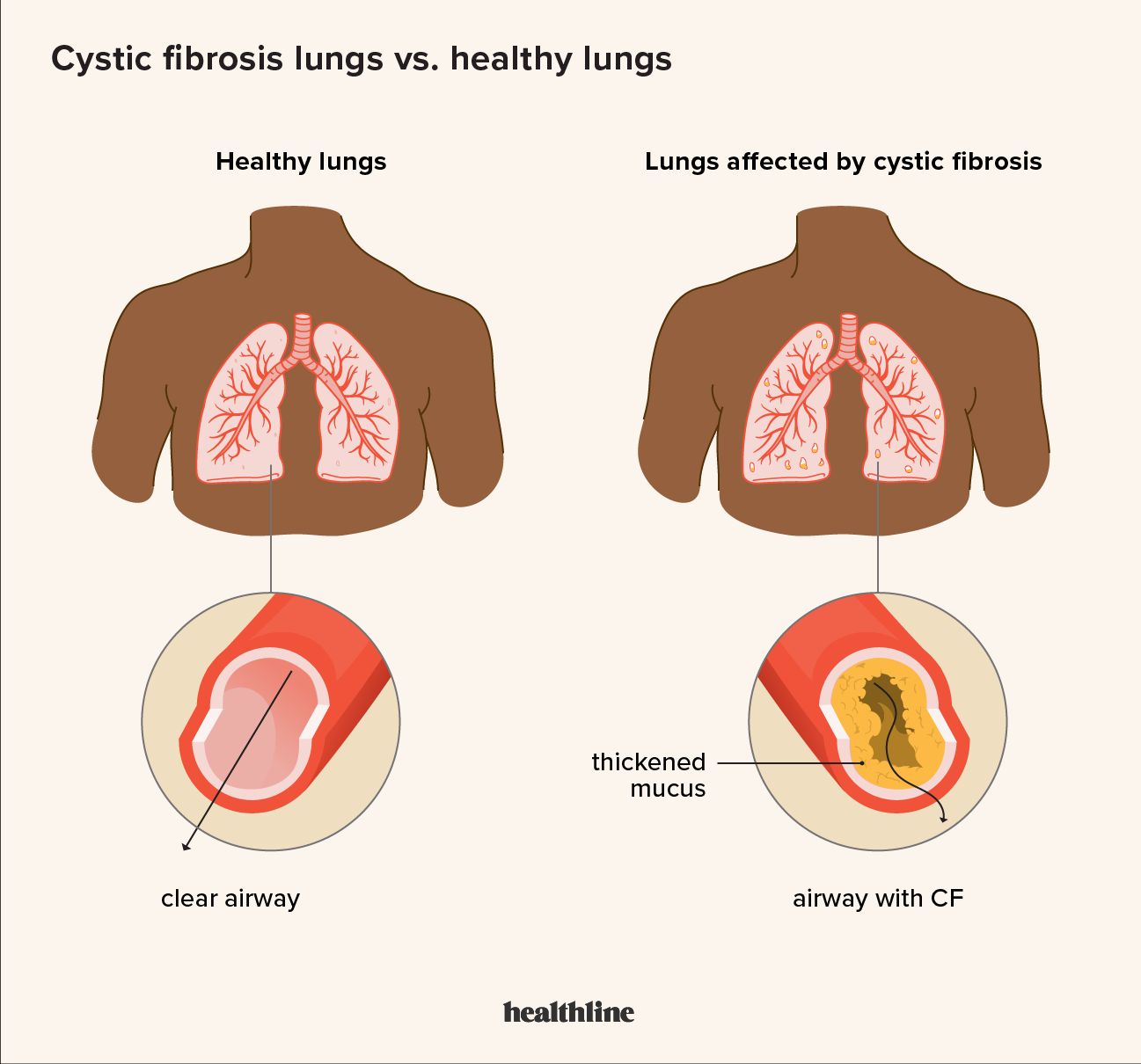 An illustration of the difference between healthy lungs and ones with cystic fibrosis.
