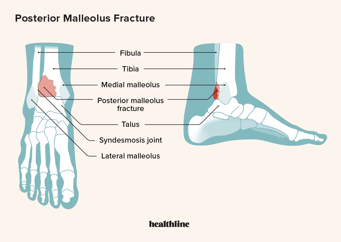 ภาพประกอบแสดงกายวิภาคของข้อเท้าและตำแหน่งที่อาจเกิดการแตกหักของมัลลีโอลัสด้านหลัง
