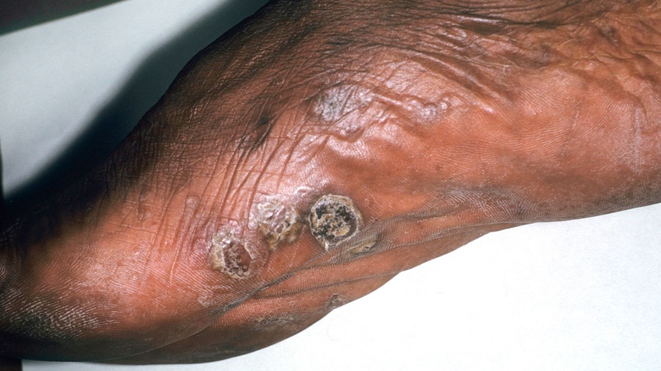 dyshidrotic eczema fingers