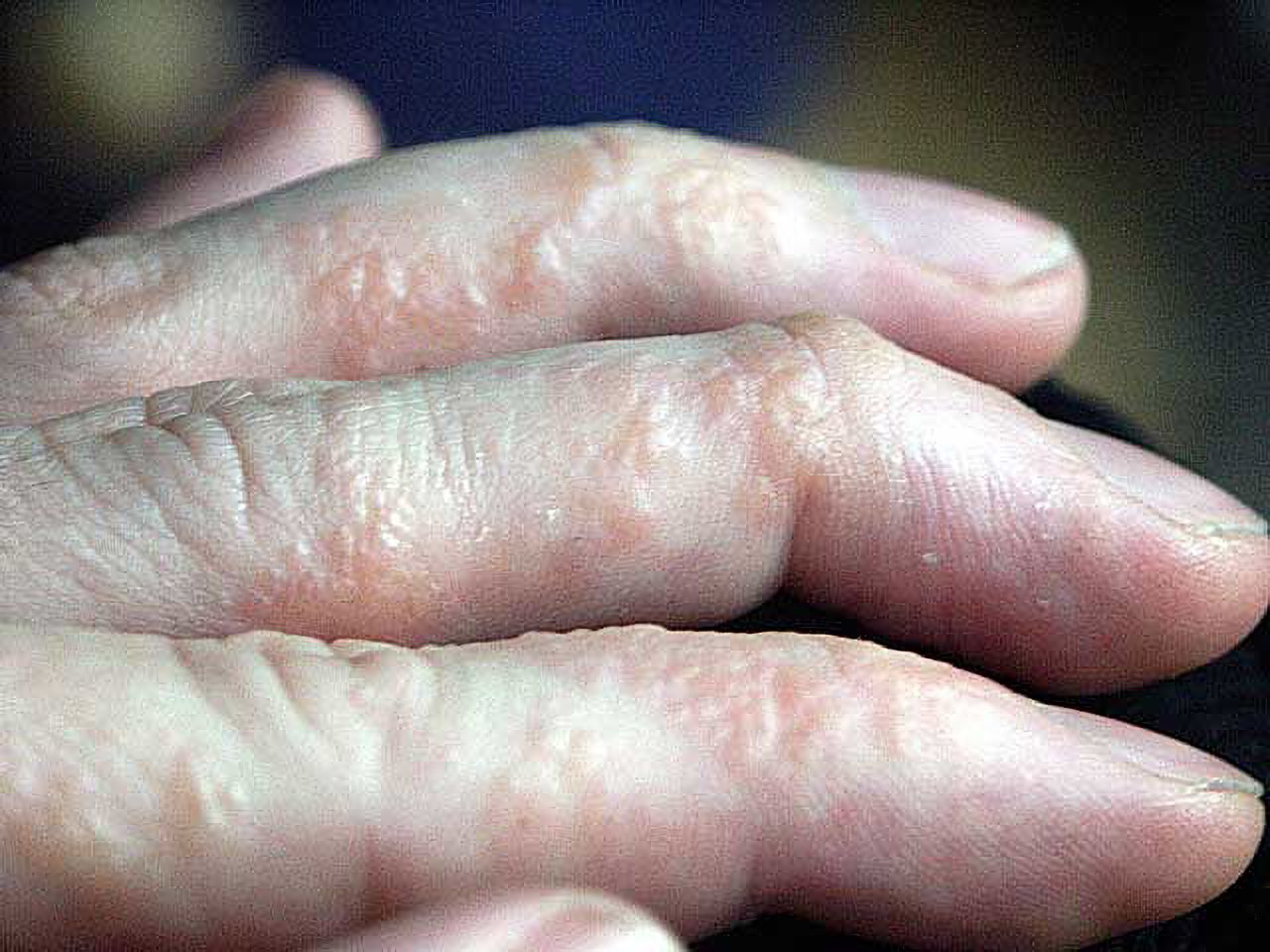 Dyshidrotic eczema: symptoms, causes, and treatment