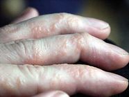 Dyshidrotic Eczema Fingers
