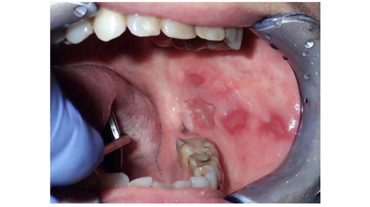 squamous cell carcinoma mouth
