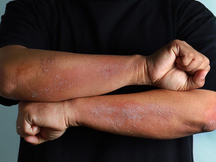 The Differences Between Mild, Moderate, and Severe Psoriasis