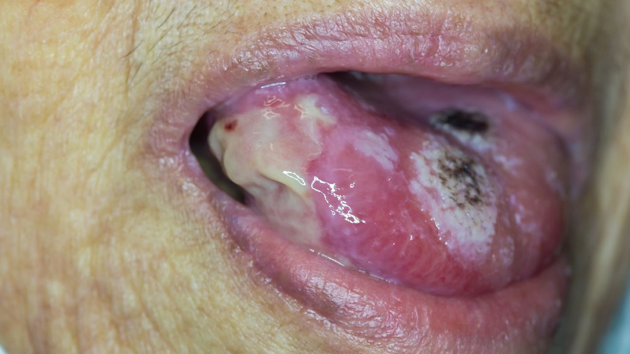 Oral Cancer  Mouth Cancer Symptoms