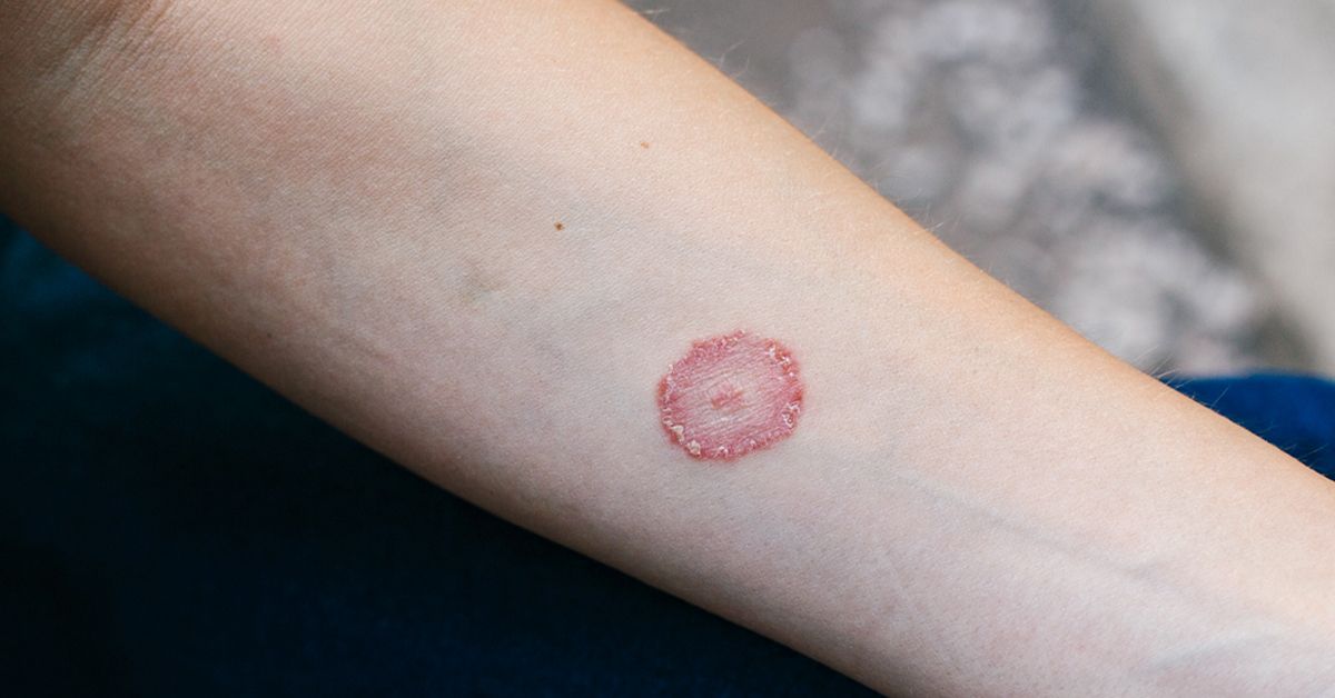 Ringworm: Symptoms, Treatment, and Home Remedies