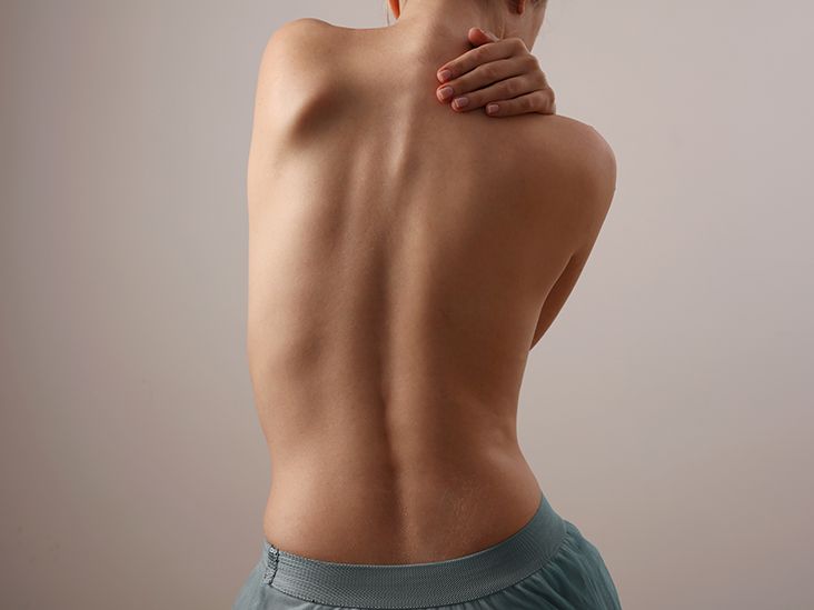 scoliosis spine curvature