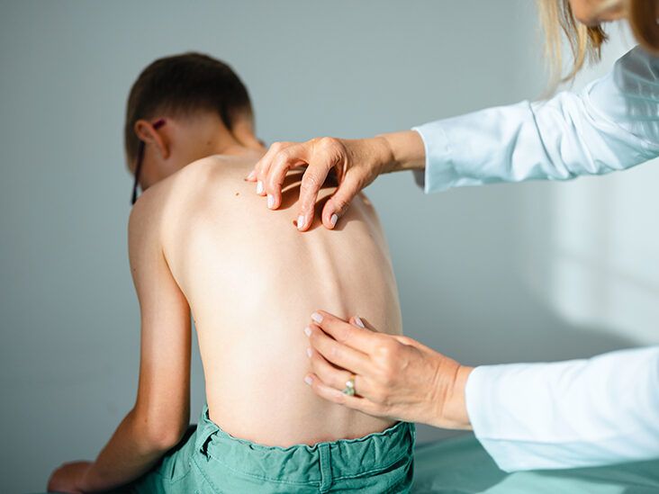 Thoracic Scoliosis: Symptoms, Causes, Treatments, and More