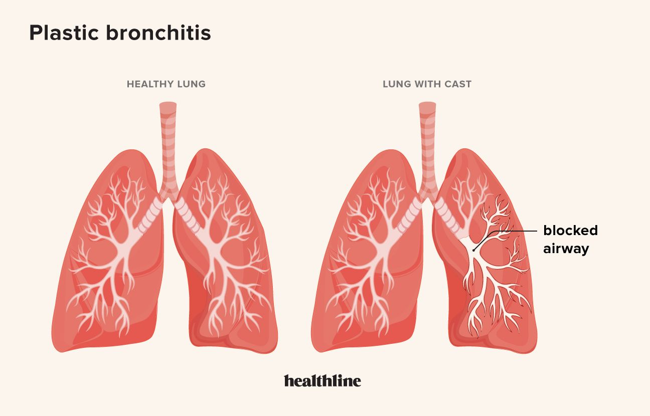 plastové odlitky na bronchitidu
