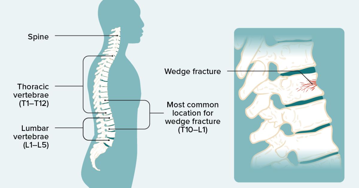 Vertebral Body and Compression Fractures