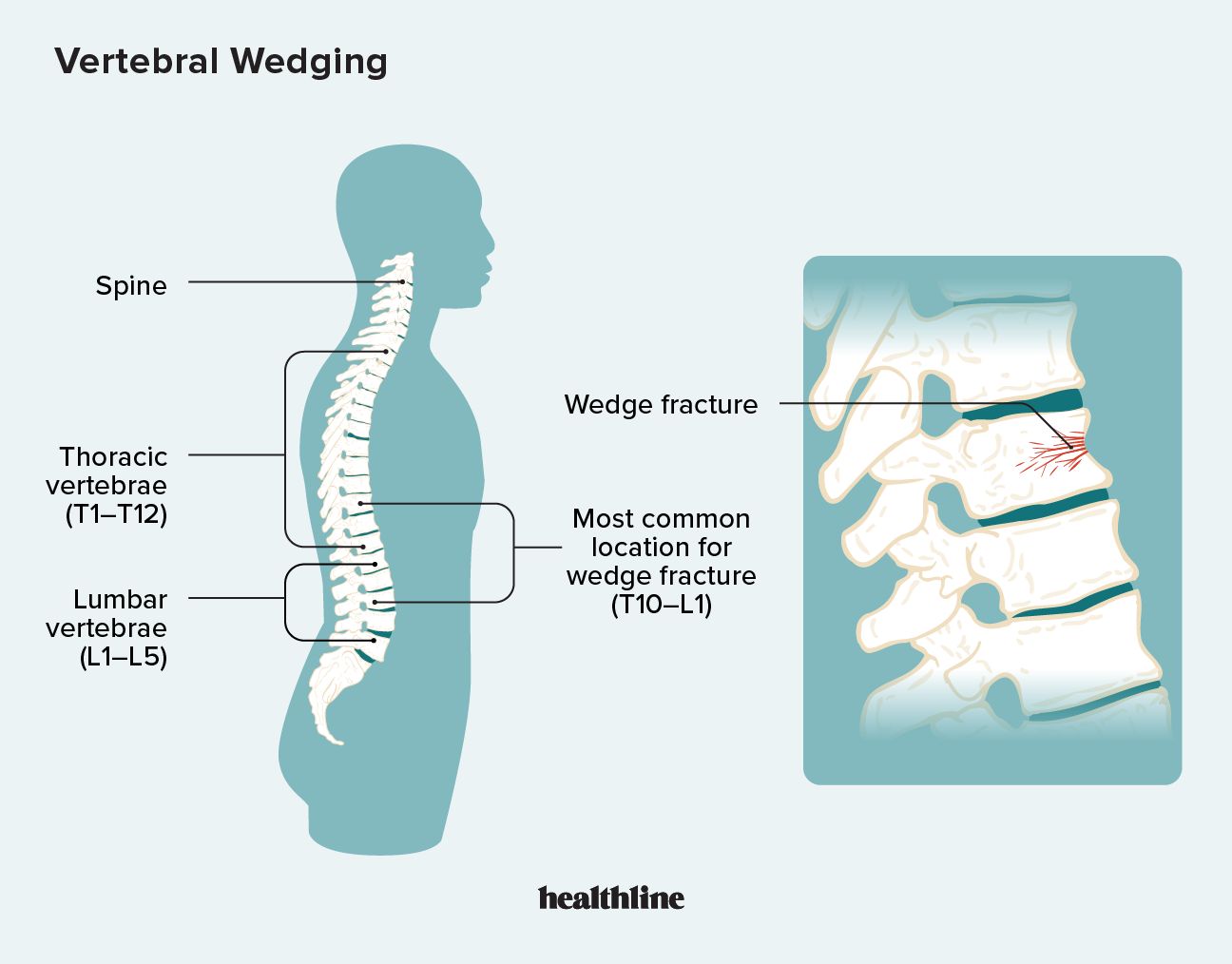 vertebral wedging