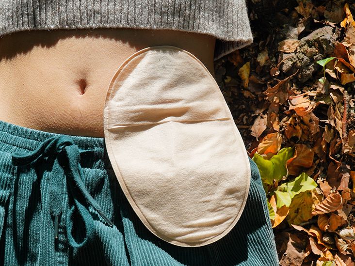 Why do I need to wear an ostomy pouch?