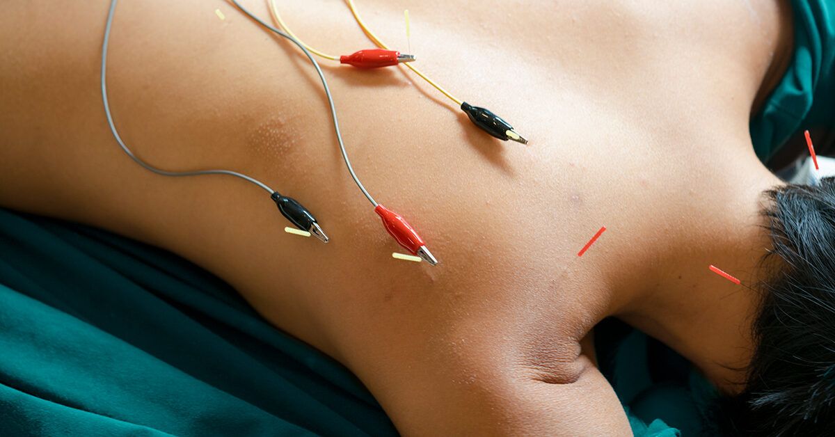 Electro-Acupuncture  What Does E-Stim Feel Like - Does it hurt?