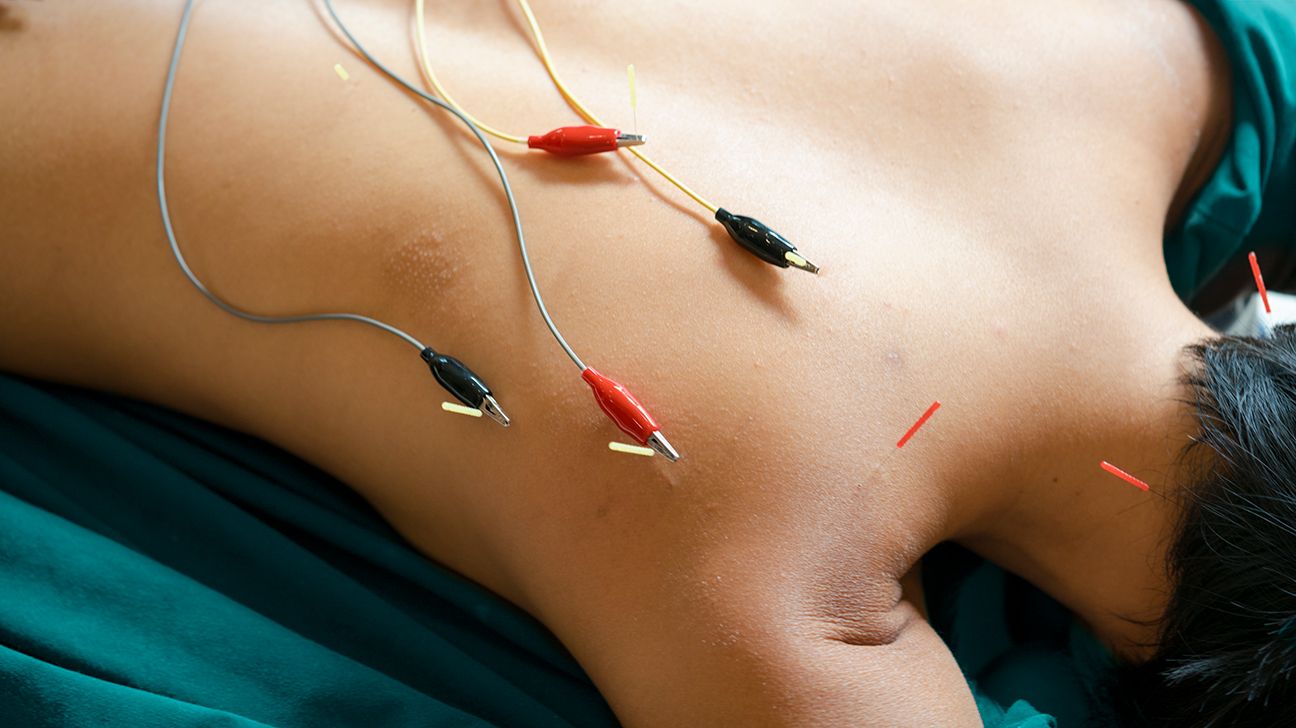 electroacupuncture needles with alligator clips on a bare back