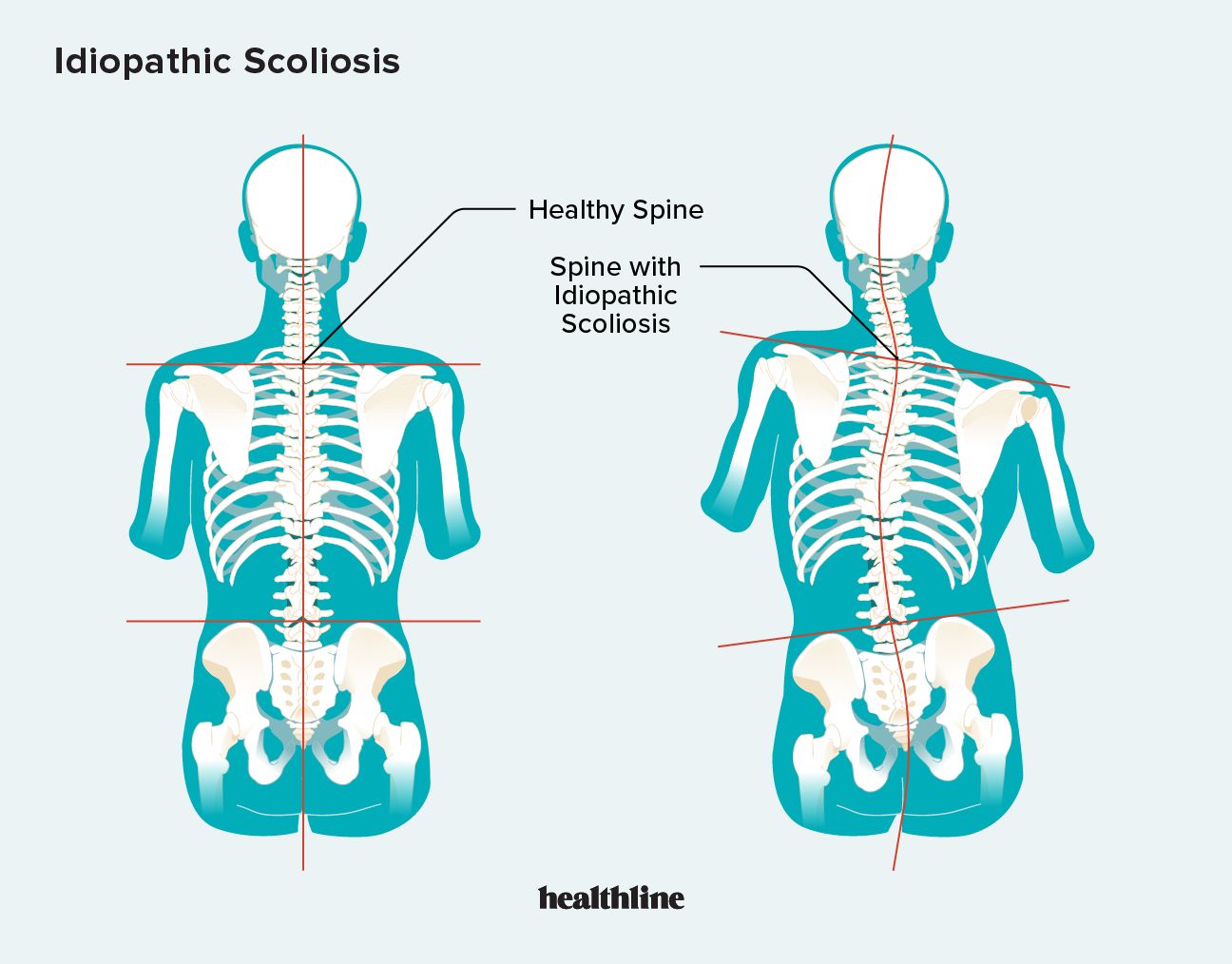 idiopathic scoliosis