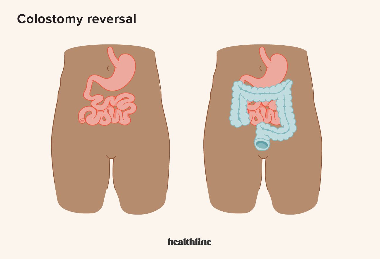 colostomy reversal illustration