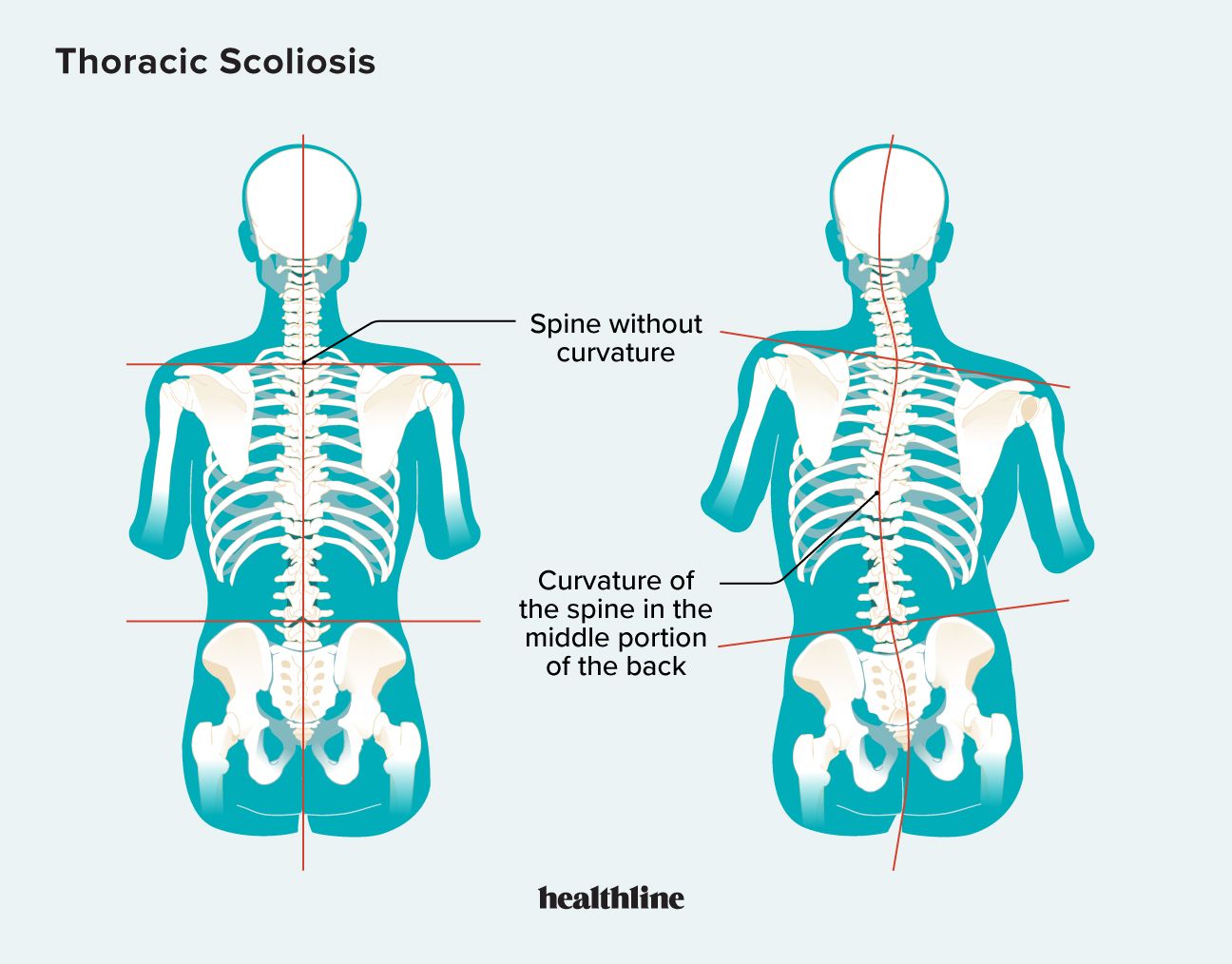 thorax skolios