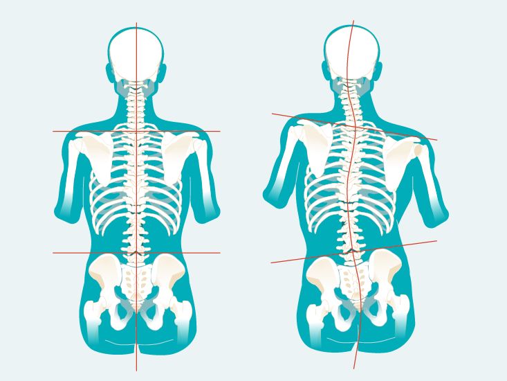Thoracic Scoliosis: Symptoms, Causes, Treatments, and More