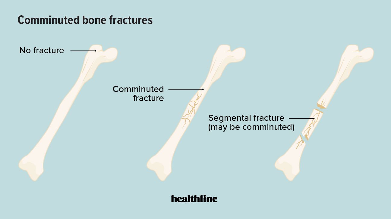 bones with no fracture, comminuted fracture, and segmental fracture