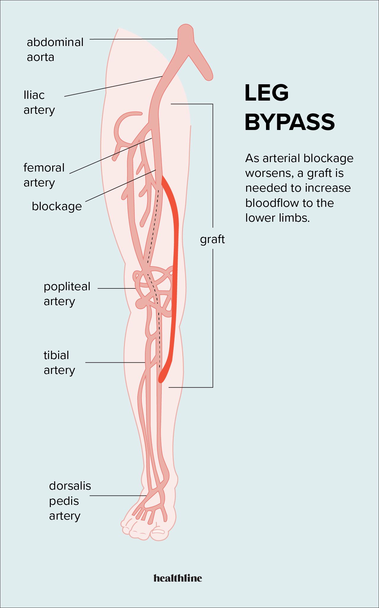 Beinbypass-Operation: Was Sie wissen sollten