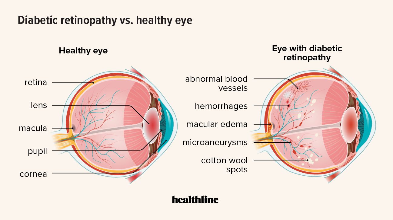 Che aspetto ha una tipica retina rispetto a qualcuno con retinopatia diabetica