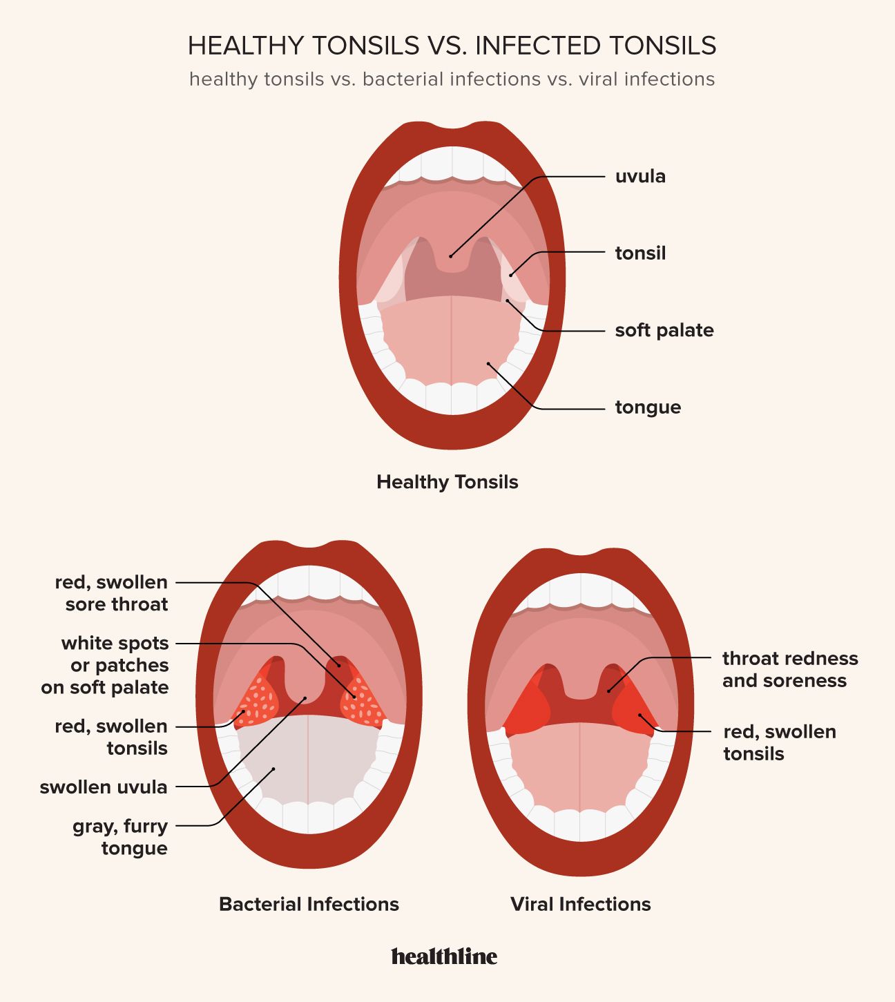 Illustration showing how to examine your tonsils and what to look for