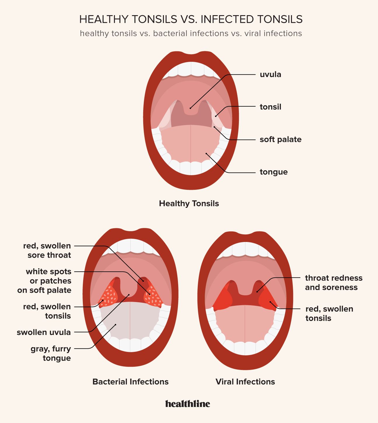 Tonsils Examination: What to Look For and When to Seek Medical Help