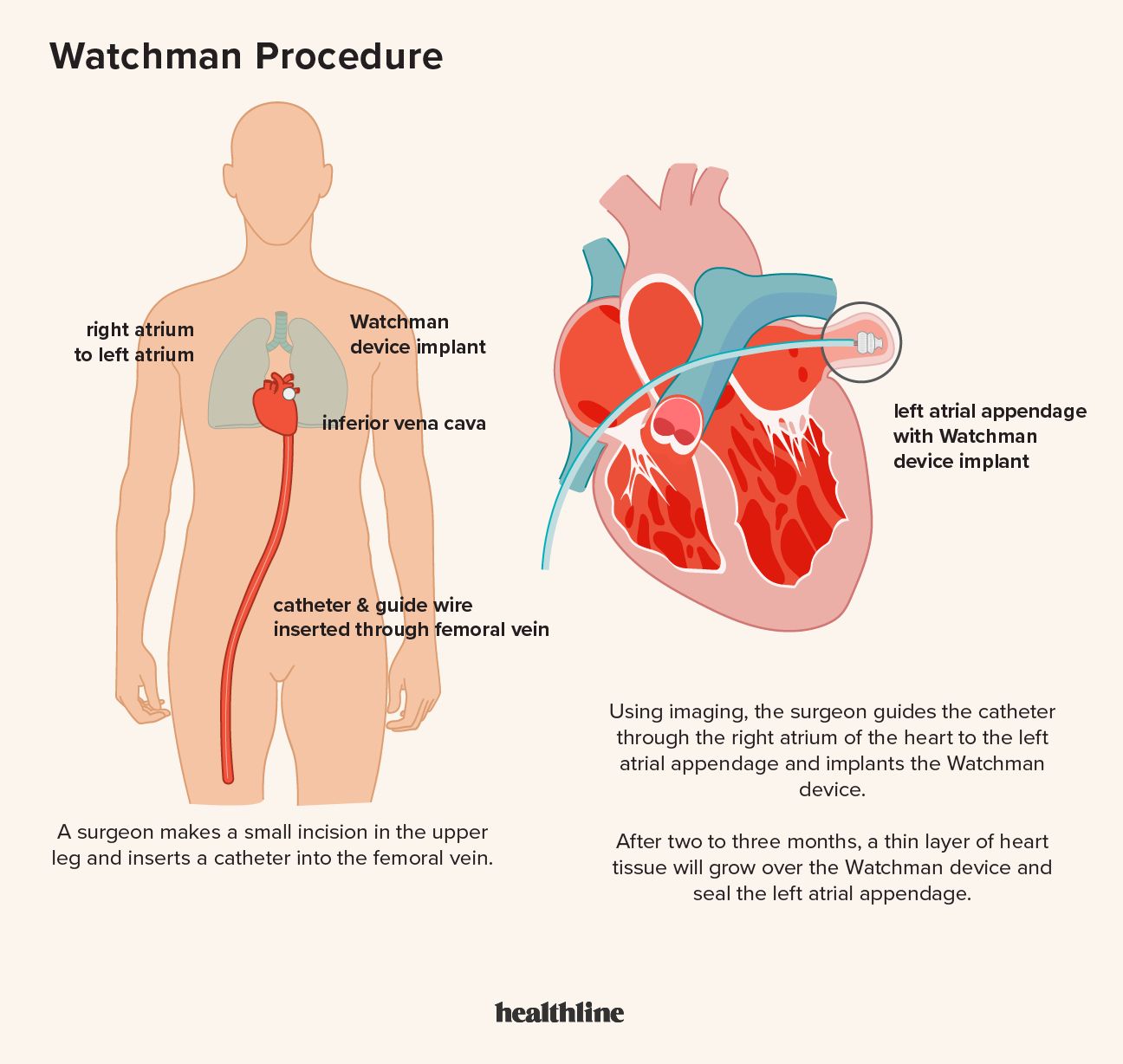 Illustration, der viser, hvordan en Watchman-enhed implanteres