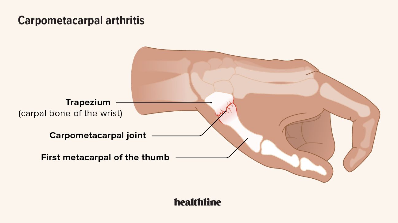 Illustration of carpometacarpal arthritis