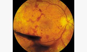 Retinal Hemorrhage Hypertension Hypertensive Retinopathy Associated