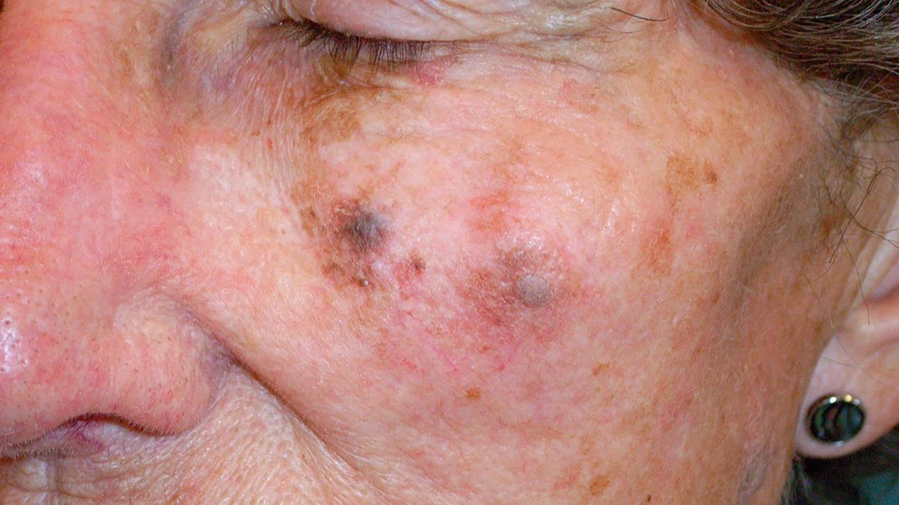 Melanoma Skin Cancer On Face