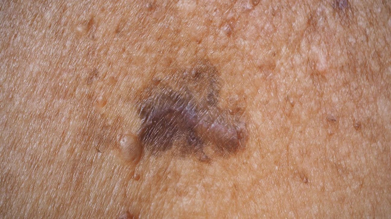 Superficial spreading melanoma