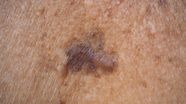 Melanoma Pictures Skin Changes And What To Look For