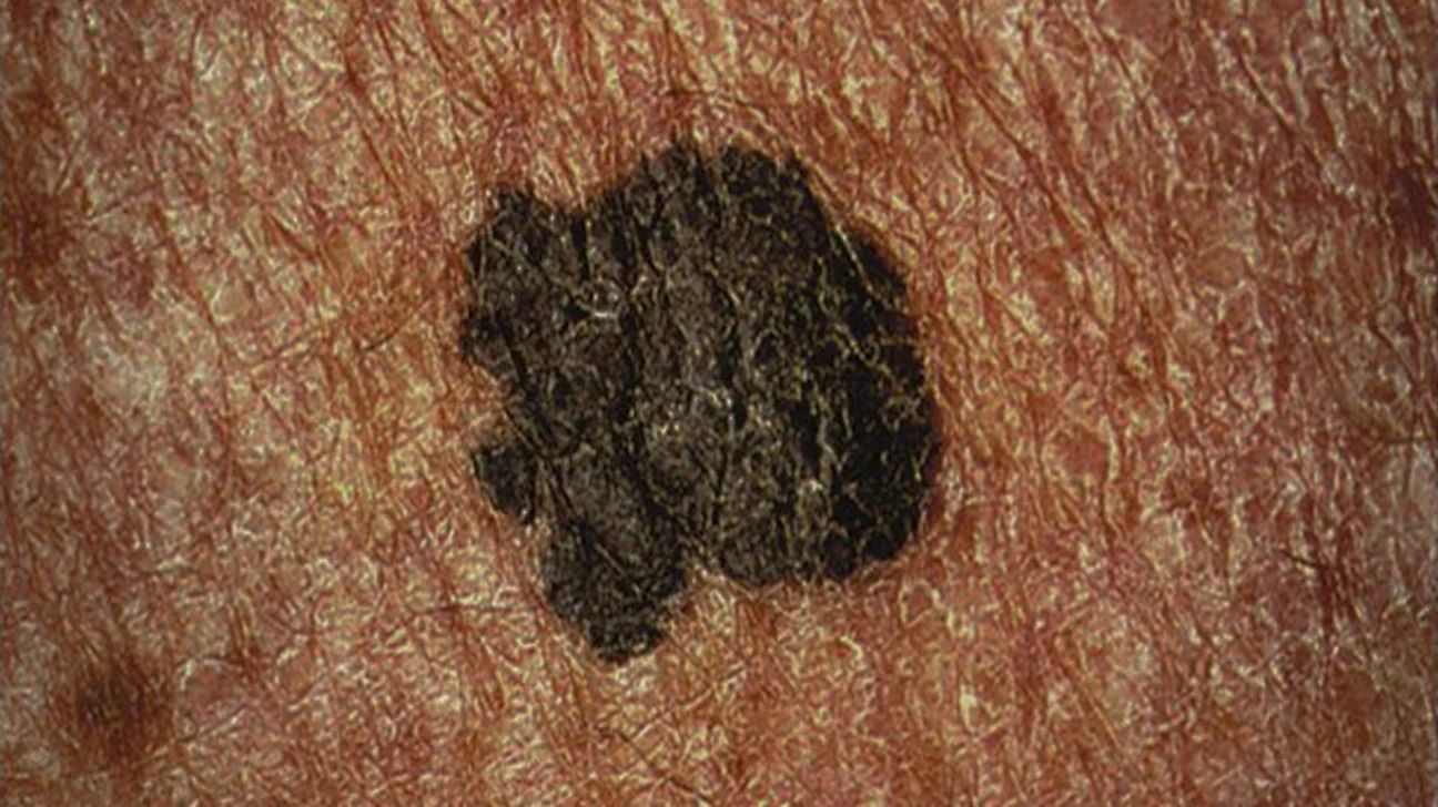 Superficial spreading melanoma on darker skin