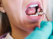 How Long Does Oral Cancer Take To Spread 