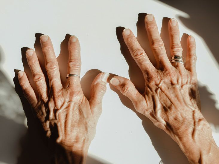 What are the signs of arthritis in the hands? - UChicago Medicine