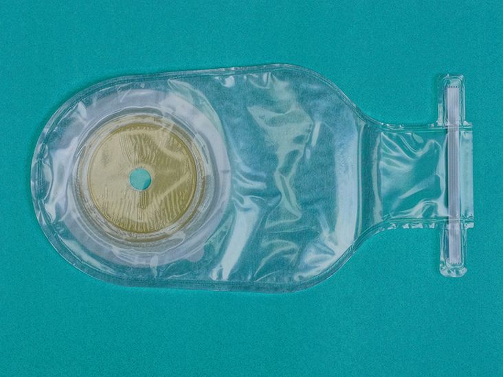 How To Avoid a Colostomy Bag