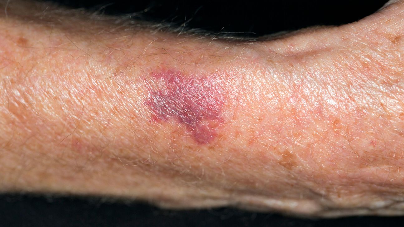 purpura on arms