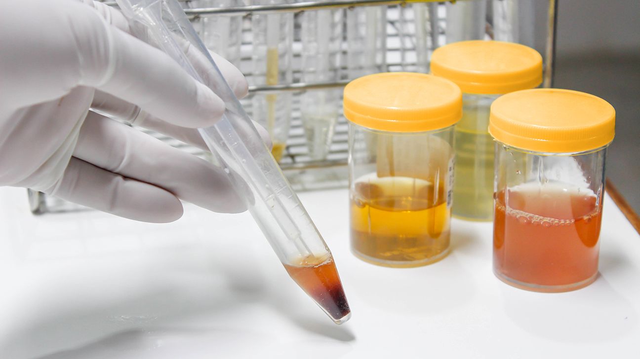 dark urine samples being tested for evidence of kidney failure 
