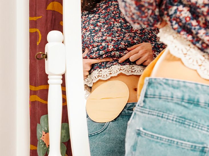 Leaking Colostomy Bag Signs, Causes, and What to Do