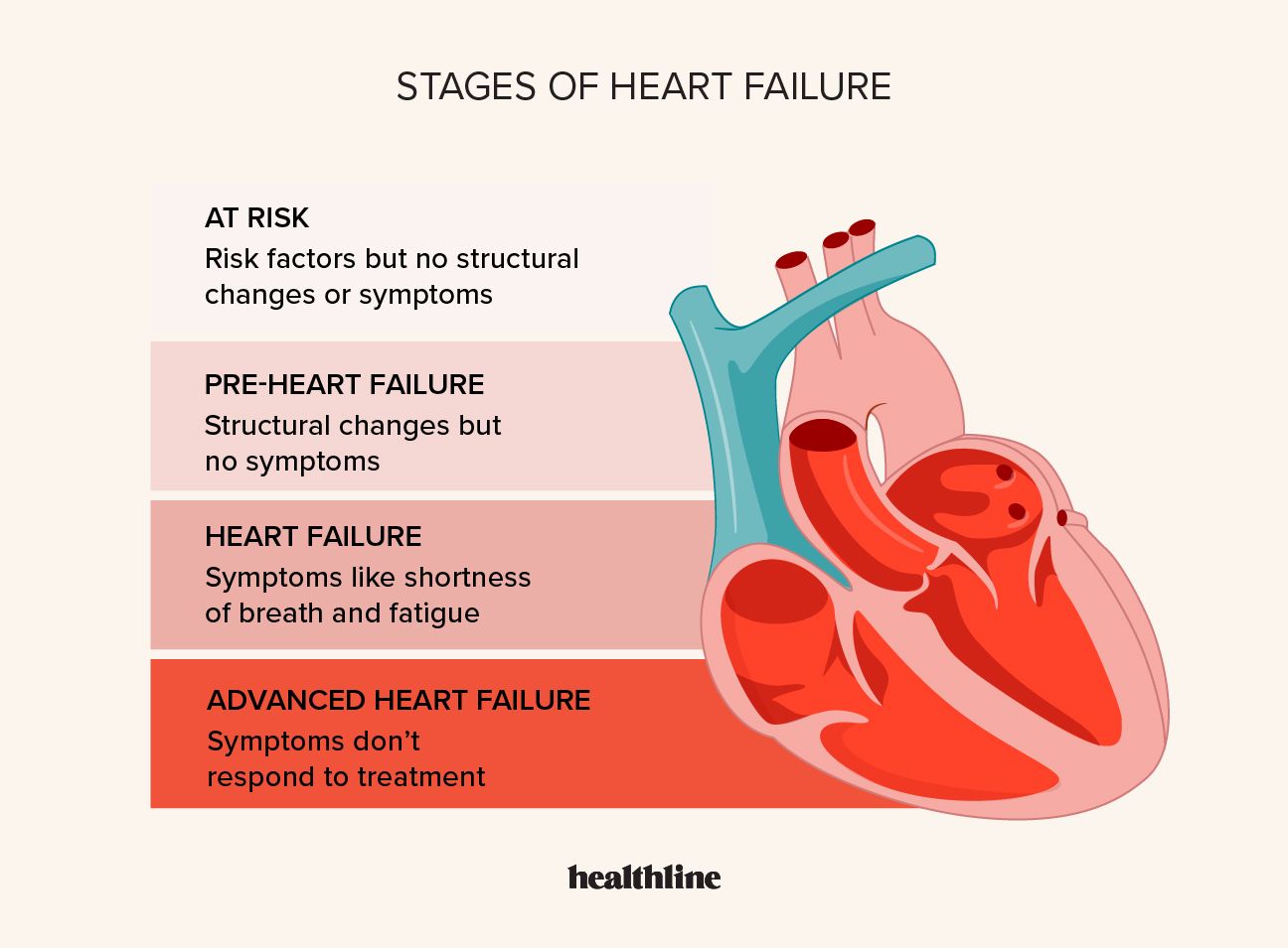етапи на сърдечна недостатъчност