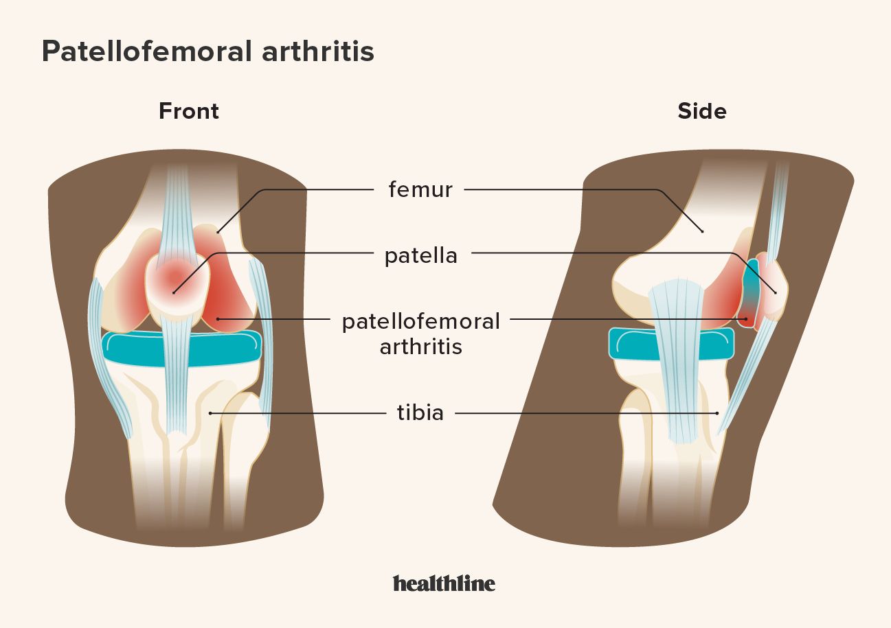 viste frontali e laterali degli effetti dell'artrite femoro-rotulea sulle strutture del ginocchio