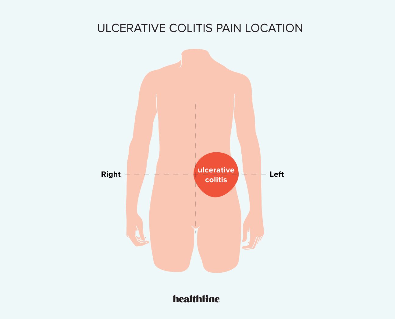 location of ulcerative colitis pain in the body