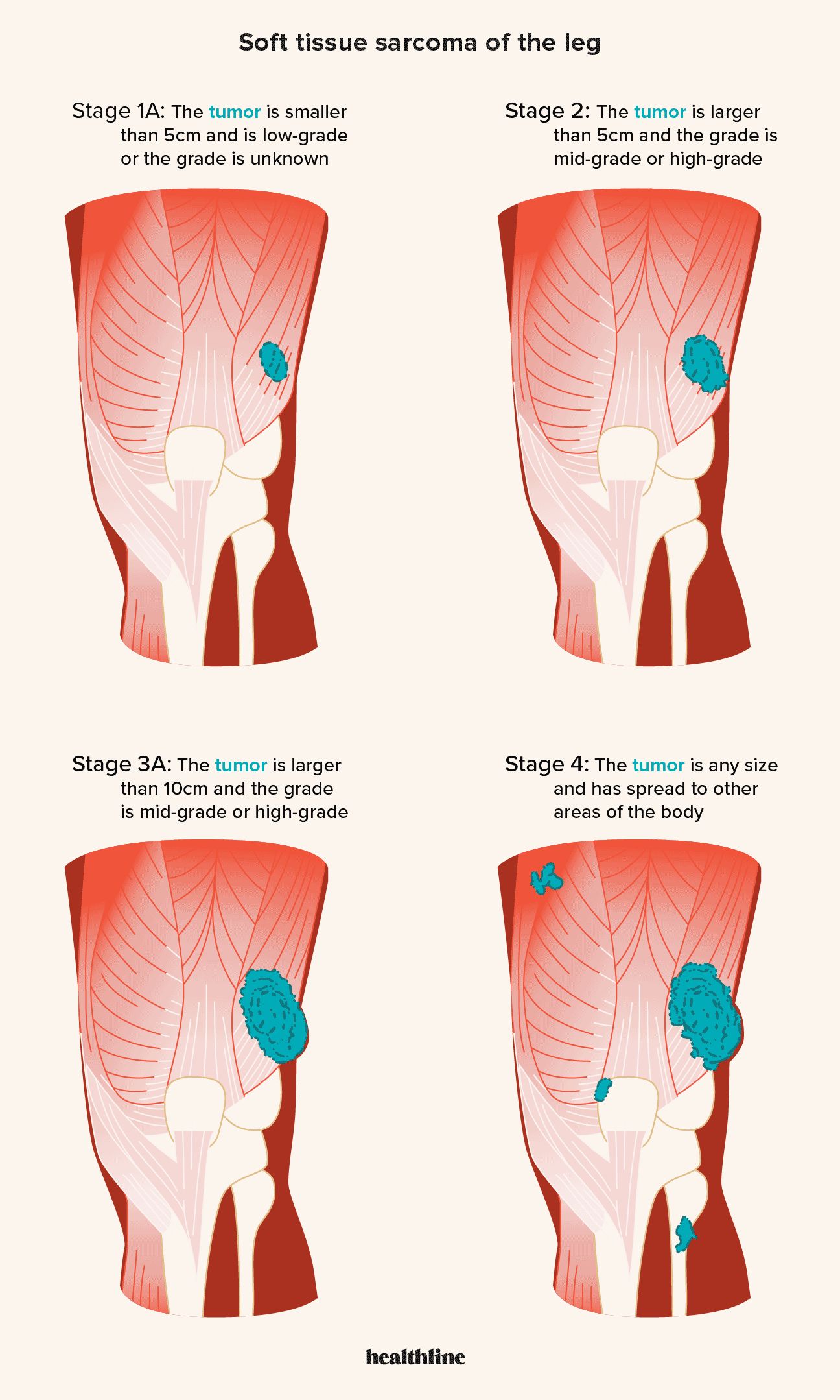 Illustrazione di sarcomi dei tessuti molli di diverse dimensioni nella gamba