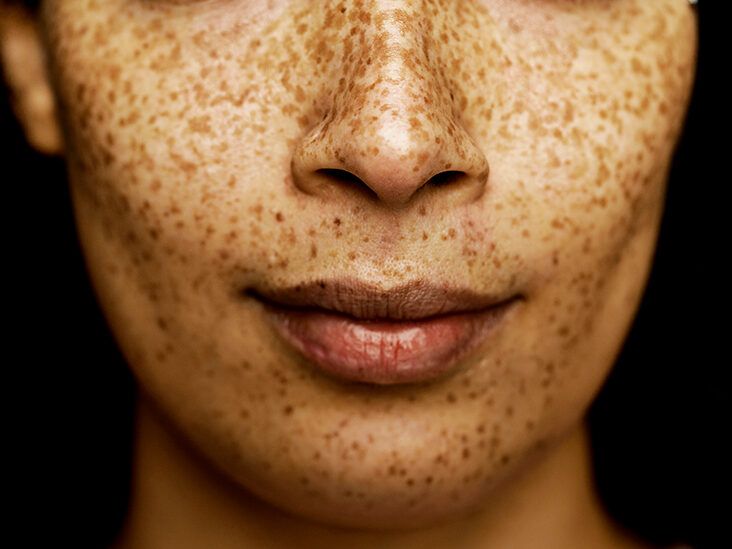 https://media.post.rvohealth.io/wp-content/uploads/2023/10/close-up-woman-face-nose-mouth-freckles-732x549-thumbnail-732x549.jpg