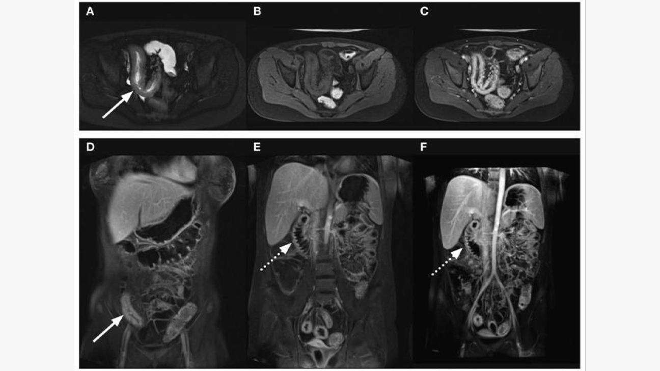 MRI showing signs of Crohn's disease