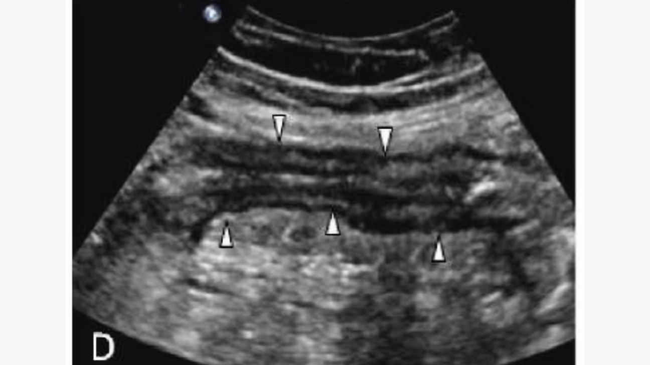 Crohn’s Disease Radiology: CT, MRI, Ultrasound, and More