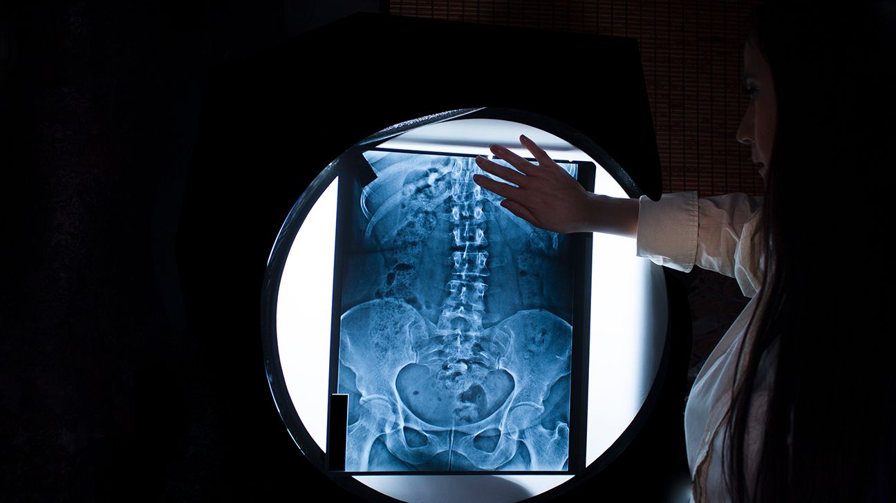 Radiografia della colonna vertebrale per un bambino con scoliosi congenita