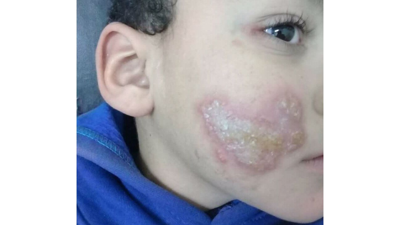 Infected Eczema: Pictures, Treatment, and More