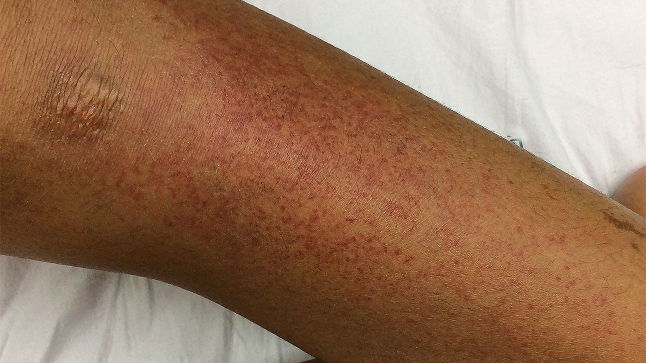 Petechiae rash on the body.