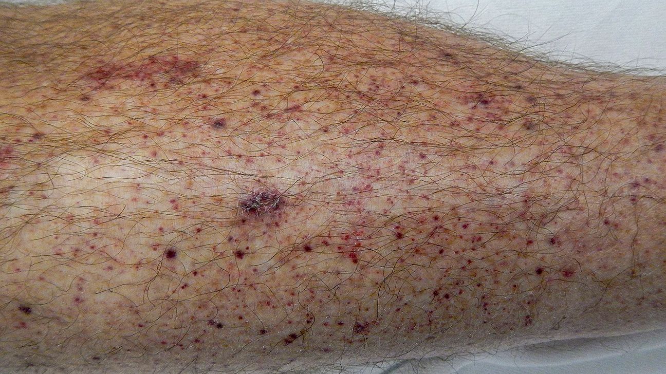 purpura rash on leg